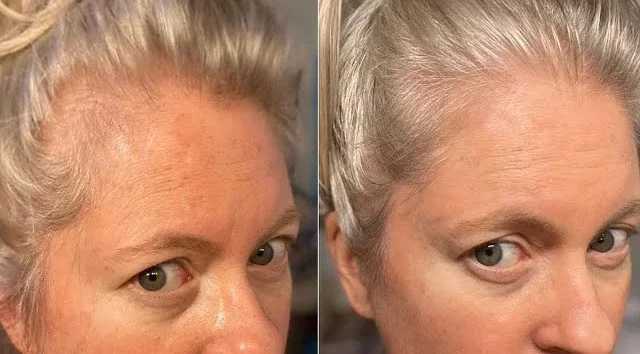 Before and after: visibly fuller hairline and denser coverage along the part after reactivating dormant follicles